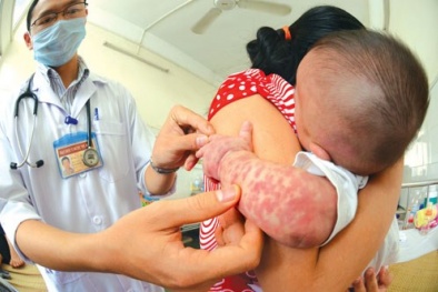 Bị sởi, nếu không đưa vào viện Nhi thì chuyển viện nào?